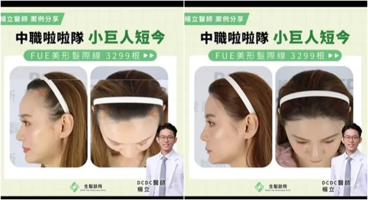 短今植髮前（左圖）後對比照曝光。翻攝短今IG