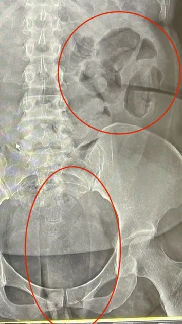 X光片顯示運毒手體內有大量毒膠囊。翻攝照片
