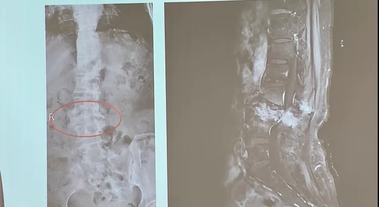 患者跌倒檢查發現不但腰椎壓迫性骨折，更在脊椎發現乳癌癌細胞，證實是乳癌骨轉移。台中醫院提供