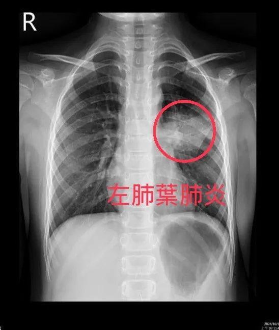 感染黴漿菌的病童有時會出現肺炎症狀，肺部X光白了一片。亞大附醫提供