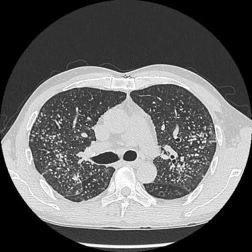 40歲男X光照出成千上萬顆肺結節。翻攝蘇一峰臉書