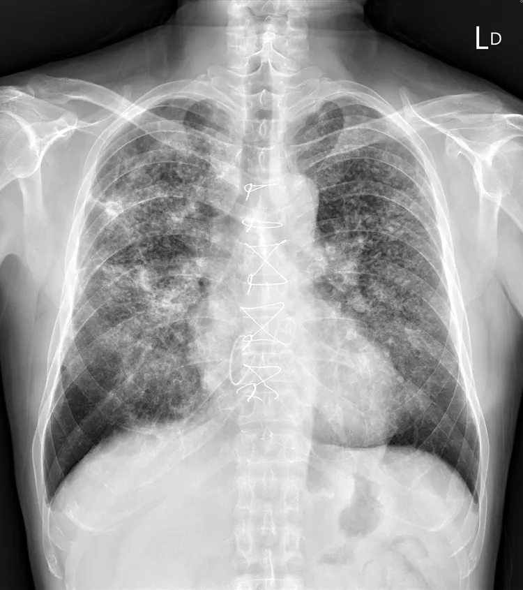 40歲男胸部X光。翻攝蘇一峰臉書