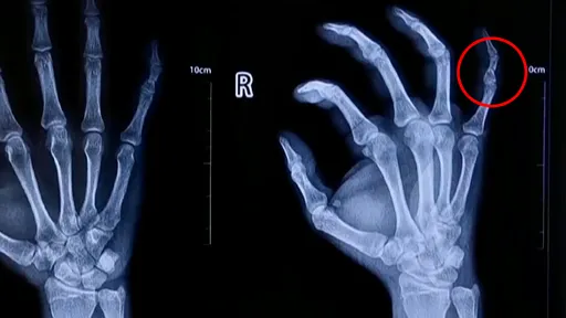 右手小拇指「1个月断30次」　他靠车祸赚90万元被逮揭露真相