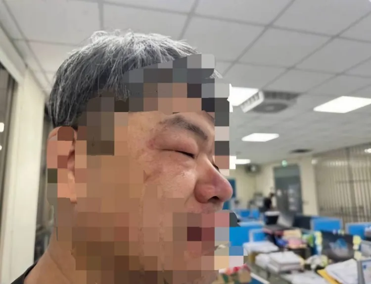 鄭員右臉負傷。新湖警分局提供