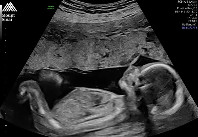 廣告小妹曬超音波照。翻攝廣告小妹臉書