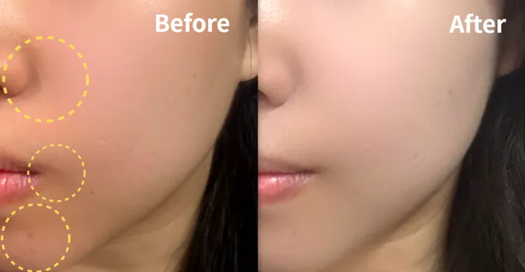 ▲ 使用前膚色較暗，鼻翼處及嘴邊、下巴，都有暗沉跟痘印，使用後膚色提亮，瑕疵變得較不明顯了。