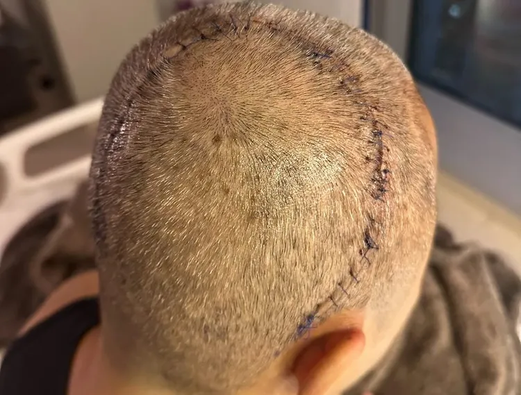 蔡一傑開腦手術留下長長的縫合痕跡。翻攝蔡一傑IG