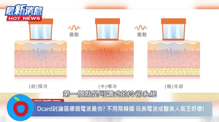 玩美電波的可調式冷卻系統，具備四段噴冷模式，醫師可以調整冷媒噴發量以維持安全的肌膚溫度