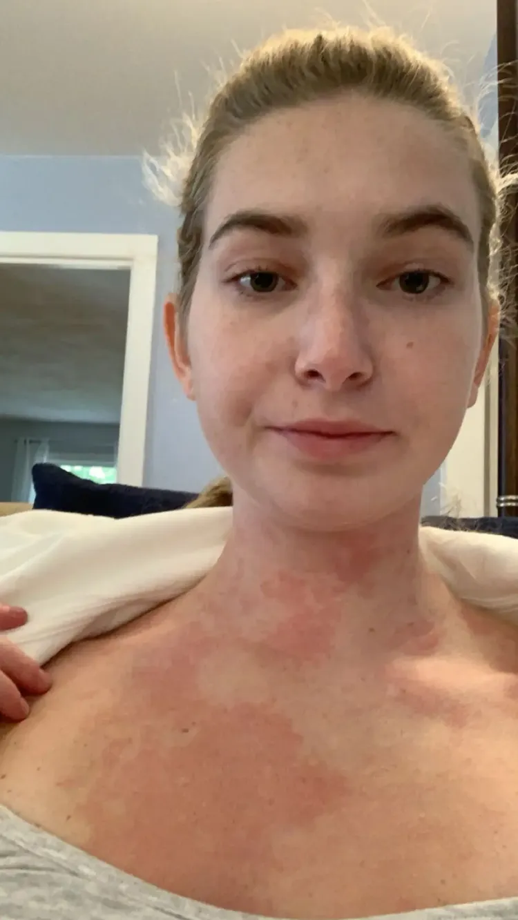 她秀出身體會出現的潮紅反應。翻攝Jam Press Vid/@carolinecray2