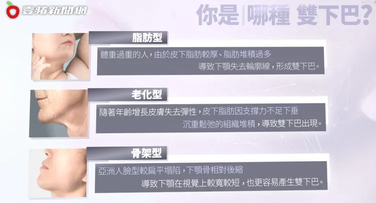 雙下巴可分為脂肪型、老化型、骨架型3種類