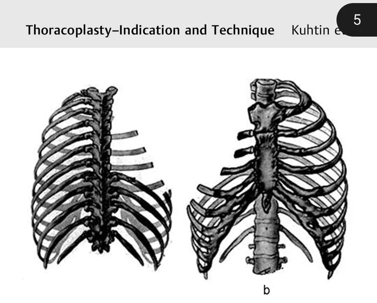 蘇一峰曝病患肋骨被切六七根，是為了保命。翻攝蘇一峰臉書