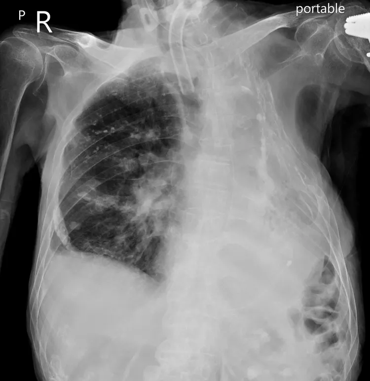 蘇一峰分享99歲病患的X光照。翻攝蘇一峰臉書