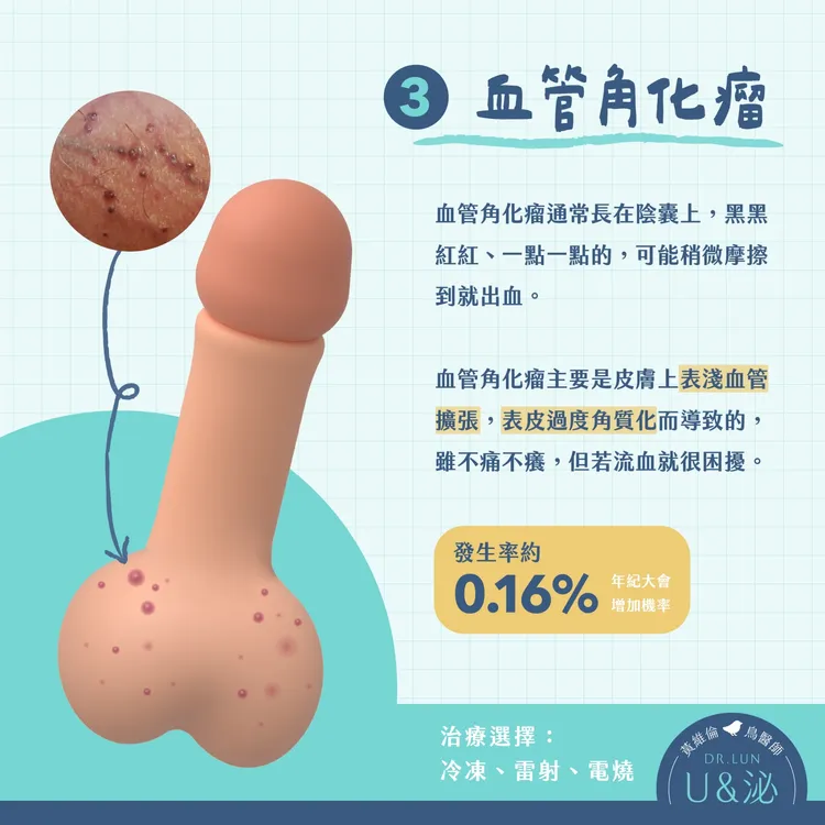 血管角化瘤。取自泌尿科醫師黃維倫粉專