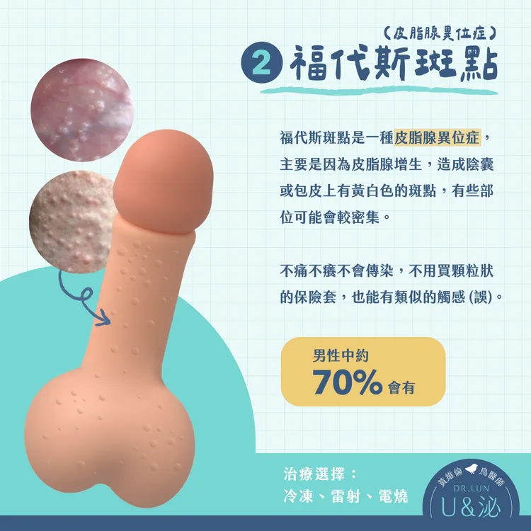 福代斯斑點。取自泌尿科醫師黃維倫粉專