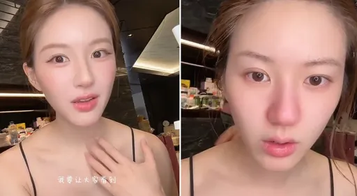 趙露思拍卸妝片證明「我也有痘」　指出曬斑素顏變紅鼻子