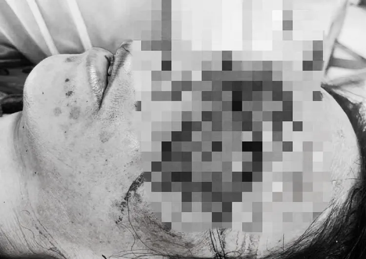 大媽踩空墜樓「眼球竟掉進鼻腔」。翻攝微博