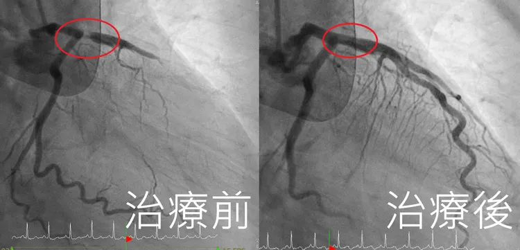 患者左前降支冠狀動脈阻塞高達99%（左），醫師形容「有如公路斷崖」。亞大附醫提供