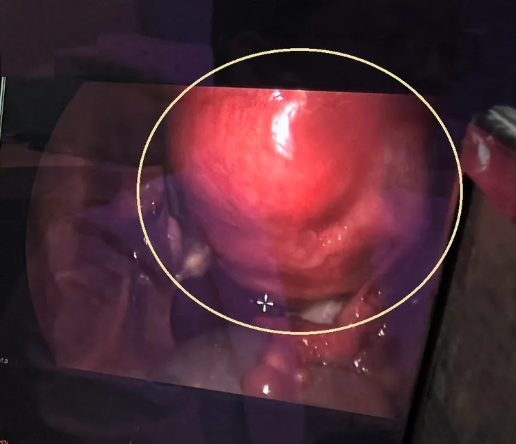 患者的子宮肌瘤不到一年從3公分長到6公分。烏日林新提供