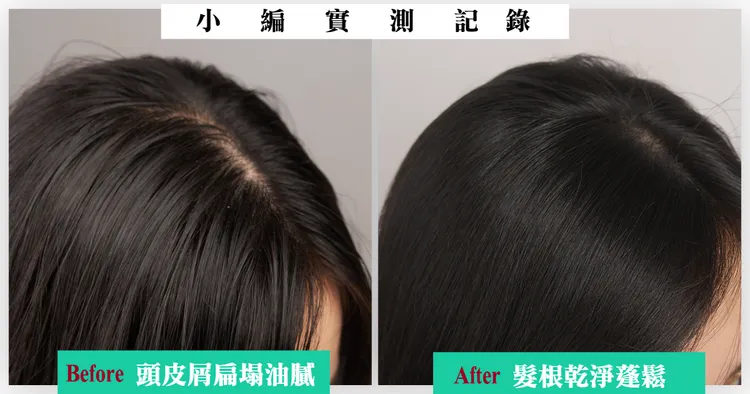 小編試用「滋潤去屑洗髮精」，原本出油、頭皮屑，頭頂還超扁塌，用完後頭皮明顯變的乾淨清爽，油膩感都沒了。