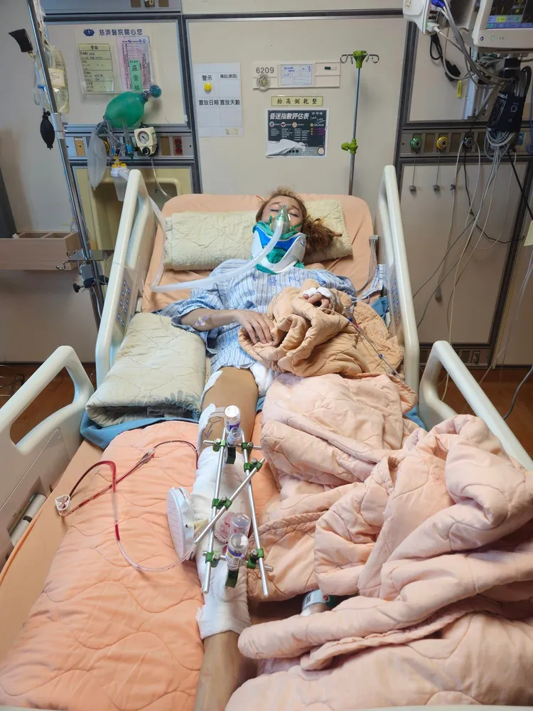 茱麗葉車禍，導致右腳骨折。翻攝Threads
