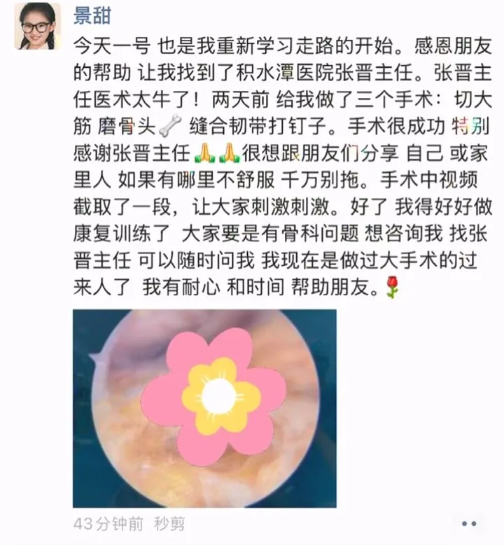 景甜透露腿部手術過程，還PO出影片。翻攝運動醫學張晉小紅書