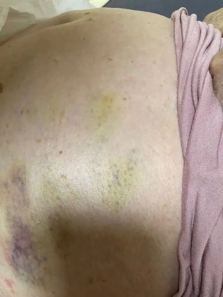 阿嬤全身多處瘀傷。民眾提供