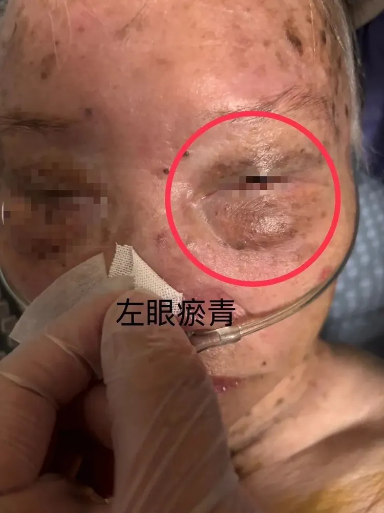 阿嬤左眼疑被打到瘀青。翻攝Dcard