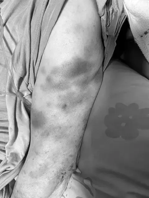 阿嬤全身瘀青。翻攝Dcard