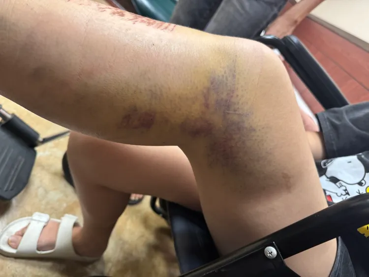 女學生左腿遭校車輾傷留下疤痕。投訴人提供