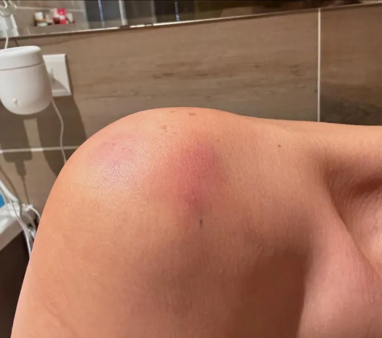 小禎肩膀的傷則是運動不當造成。翻攝小禎IG