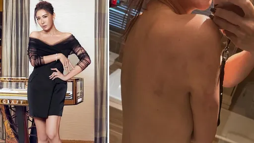 小禎突秀「脫光上空照」！被尾椎舊傷折磨20多年