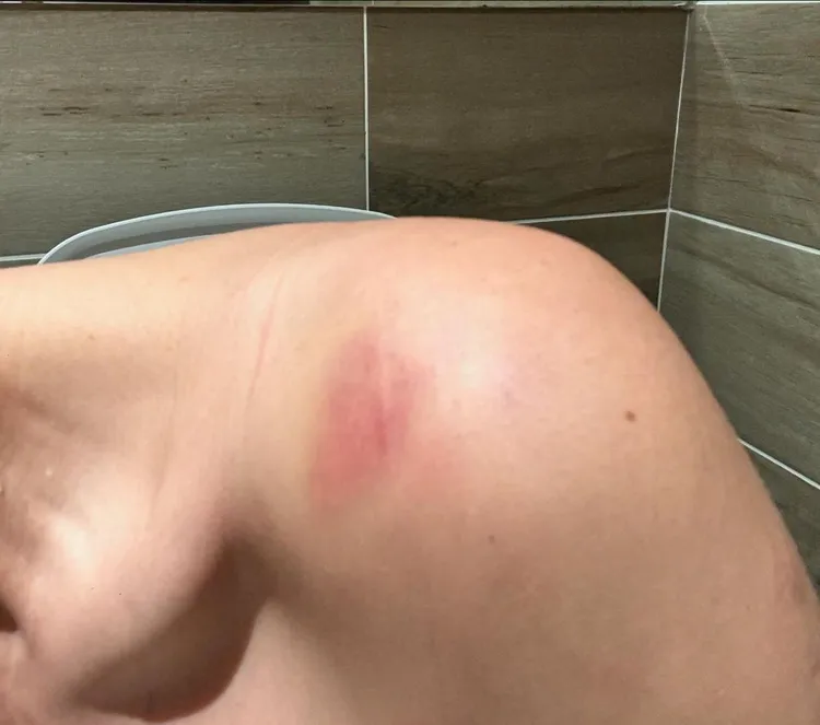 小禎肩膀舊傷曾讓她無法做大角度的動作。翻攝小禎IG