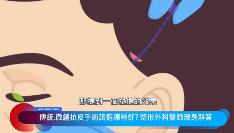 五爪拉皮手術，傷口小恢復期短。 