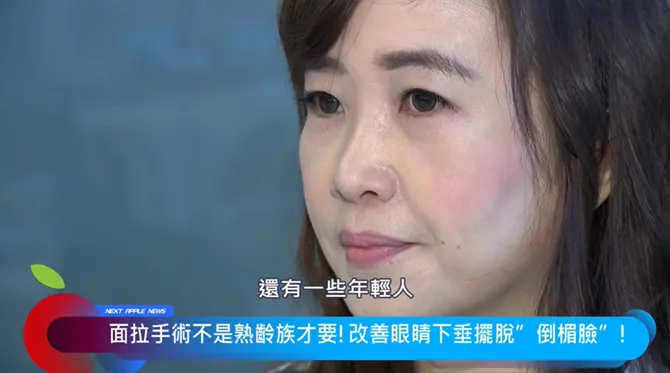 眼皮下垂、眉壓眼等問題不是只熟齡人才會出現。