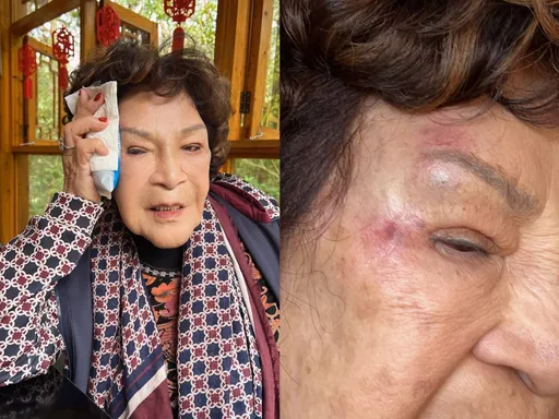 阿姑出事了!如廁重心不穩往前飛撲 臉部傷勢曝光