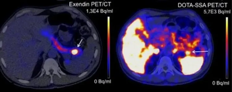 左圖為使用吉拉毒蜥的口水中化學物質合成後的掃描，可更準確找出腫瘤。翻攝自Popular Science