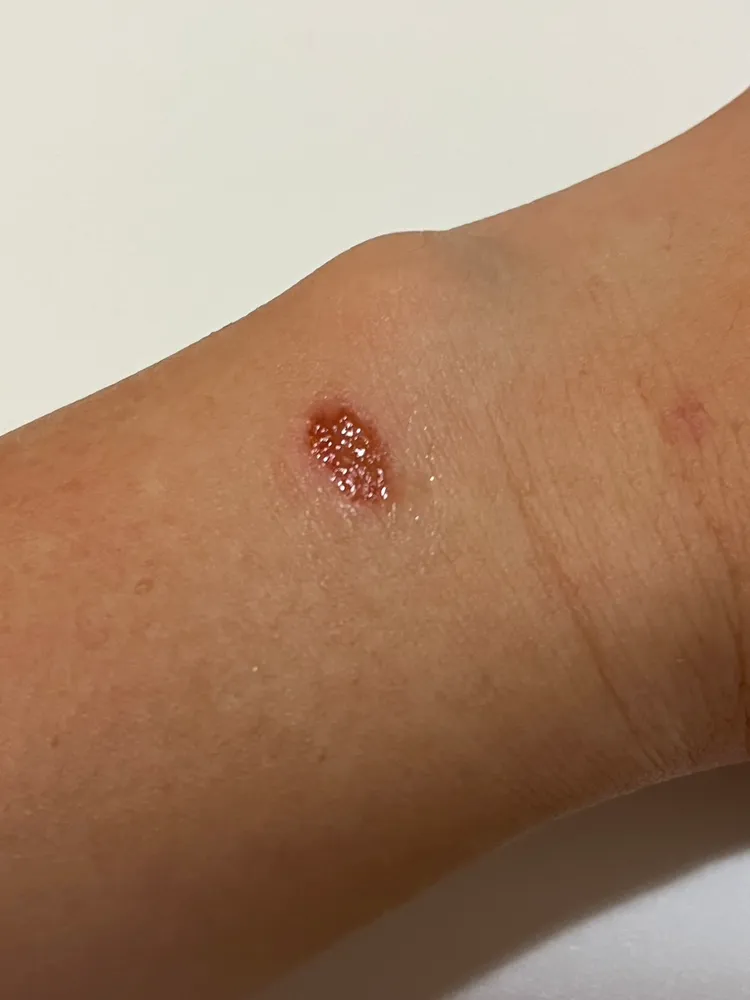 張先生的手腕疑似遭跑錶燙傷。張先生提供