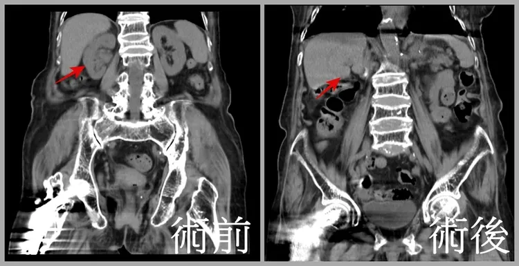 患者接受達文西手術治療並追蹤2年後，癌細胞都沒有擴散跡象，可說是成功抗癌。亞大醫院提供