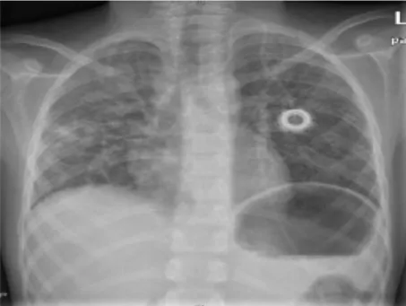 中國有醫生指出，hMPV病毒大多發生於冬末春初，目前沒有特效藥或疫苗可以應用。翻攝微博