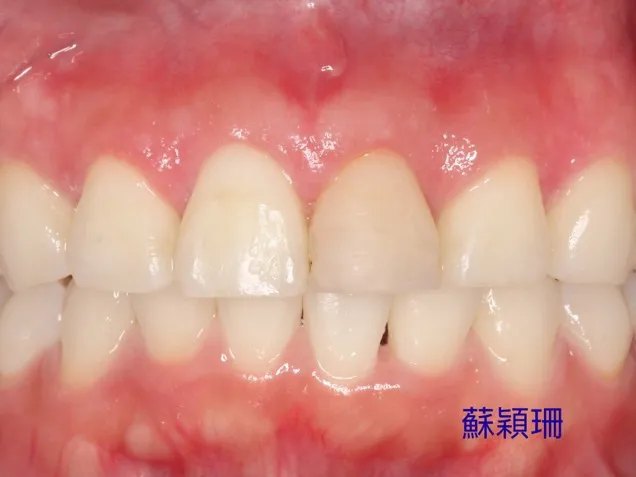 許小姐術後牙齒照。台北慈濟醫院提供