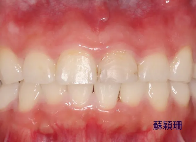 許小姐術前牙齒照。台北慈濟醫院提供