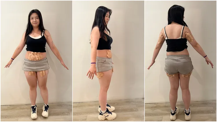 王孜妤進行埋線療程。王孜妤提供