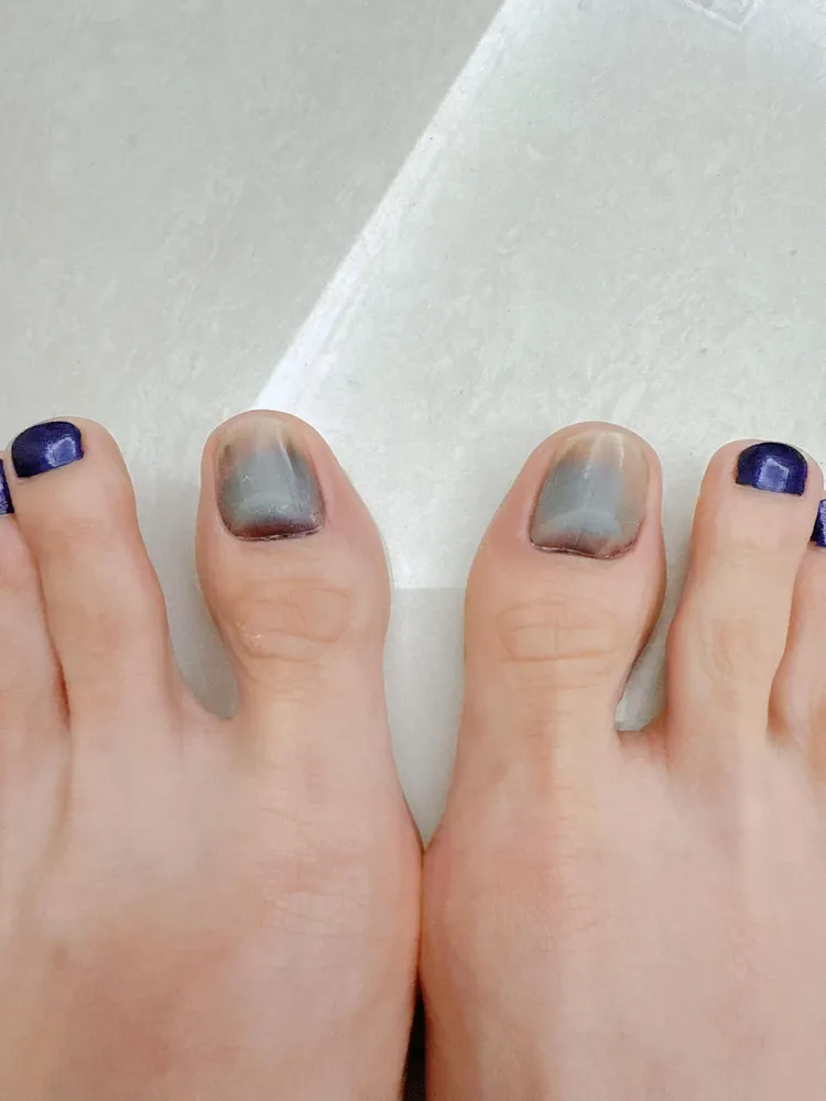 侯怡君PO出一張雙腳大拇指指甲變紫黑色照片。翻攝侯怡君臉書