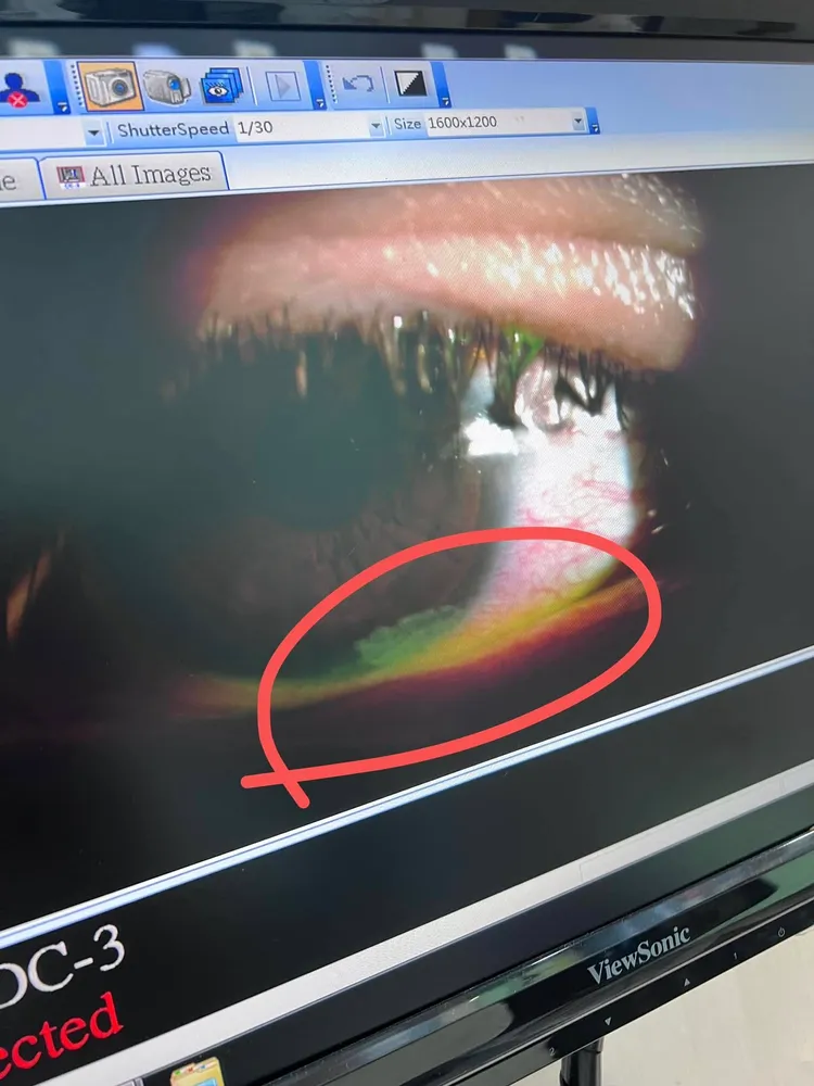 雪碧（方祺媛）的眼睛閉不上來，導致乾眼症，角膜一直潰瘍破洞。翻攝方祺媛臉書