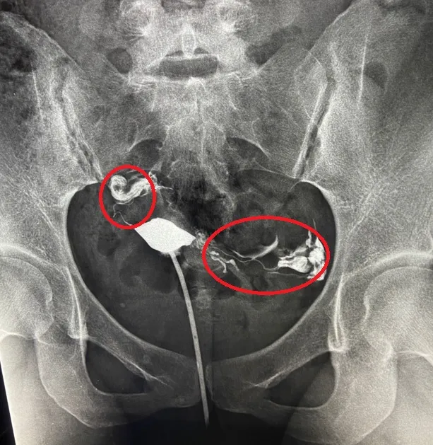 李小姐的輸卵管雙側都阻塞。茂盛醫院提供