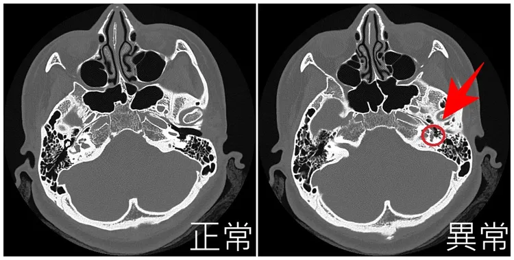 耳硬化症是因鐙骨骨質海綿化及硬化(圖右)，導致出現傳導性聽力損失。亞大附醫提供