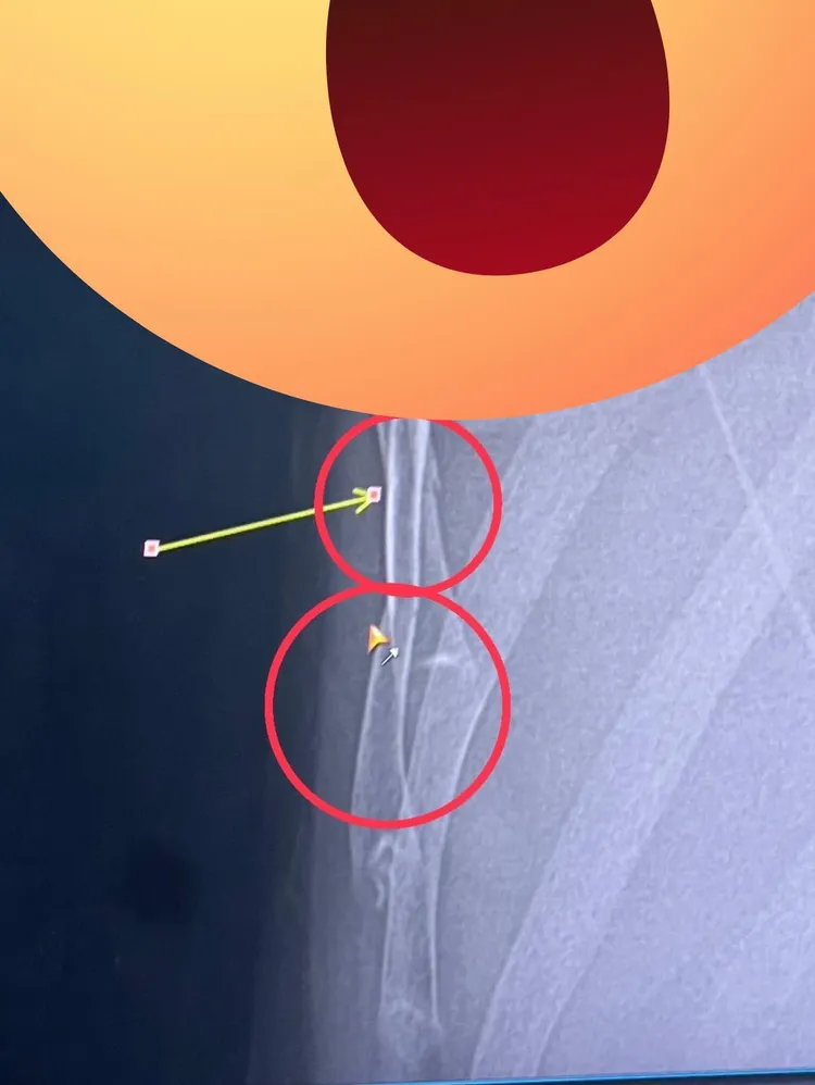雪碧跌倒肋骨斷裂兩根。翻攝雪碧臉書