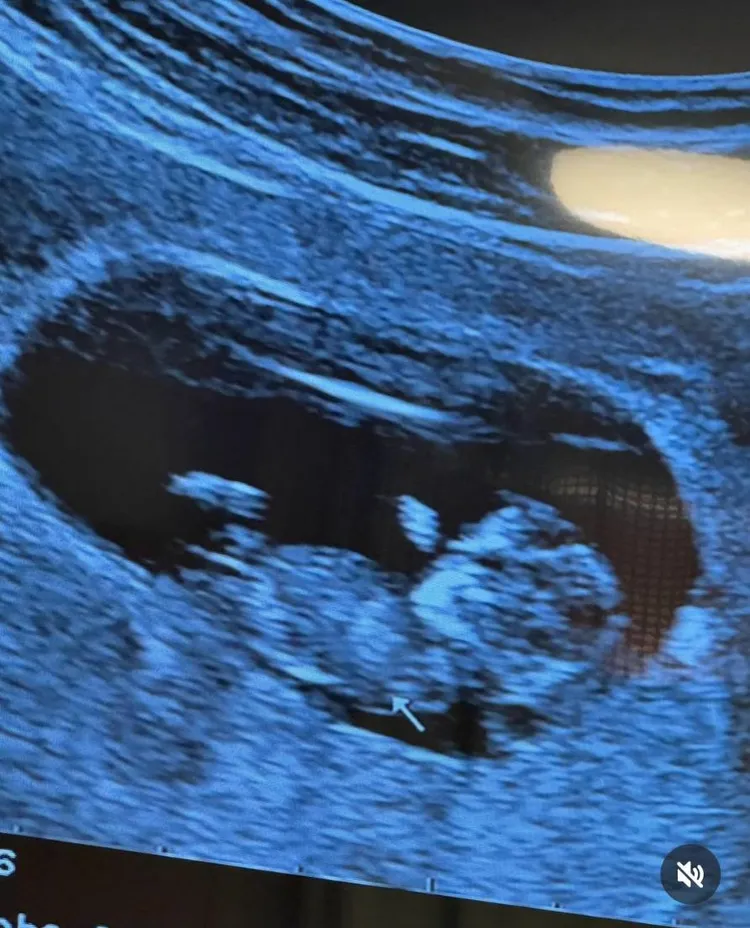 洪小鈴今天在IG秀超音波照，表示她懷孕了，懷的是女兒。。翻攝洪小鈴IG