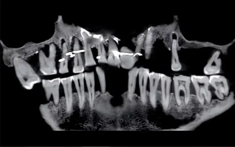 從X光照片可看到一些牙根已經搖搖欲墜。《考古雜誌》