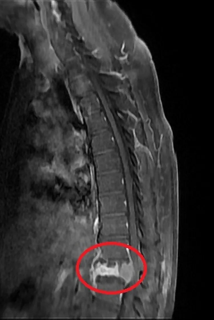 術前核磁共振顯示，第12節胸椎因腫瘤骨轉移而塌陷壓迫到神經管(左)；透過減壓及微創釘手術，將4根微創骨釘分別固定在胸椎第11節及腰椎第1節，達到穩定脊椎的作用，此為術後X光。台北慈濟醫院提供